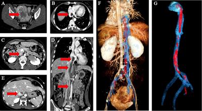 Case Report: Low-grade endometrial stromal sarcoma with intravenous and intracardiac extension: a case after misdiagnosis of endometrial stromal nodule as submucosal fibroid